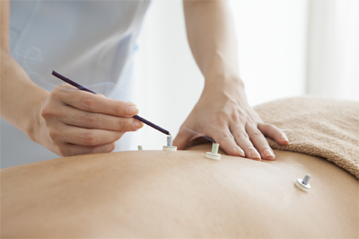 Moxibustion